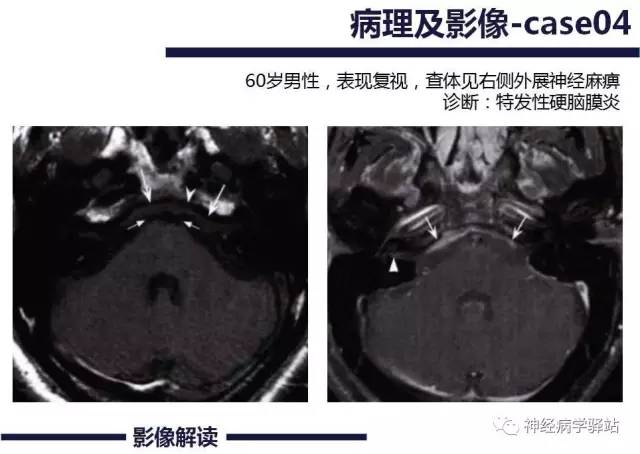 【PPT】展神经解剖、影像及临床
