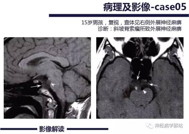 【PPT】展神经解剖、影像及临床