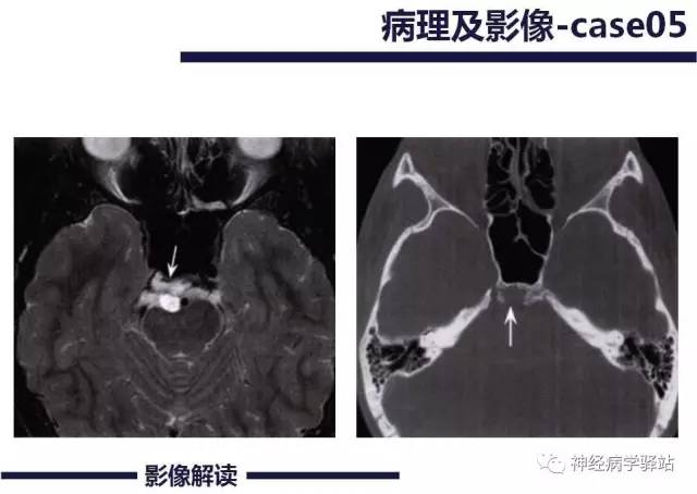 【PPT】展神经解剖、影像及临床