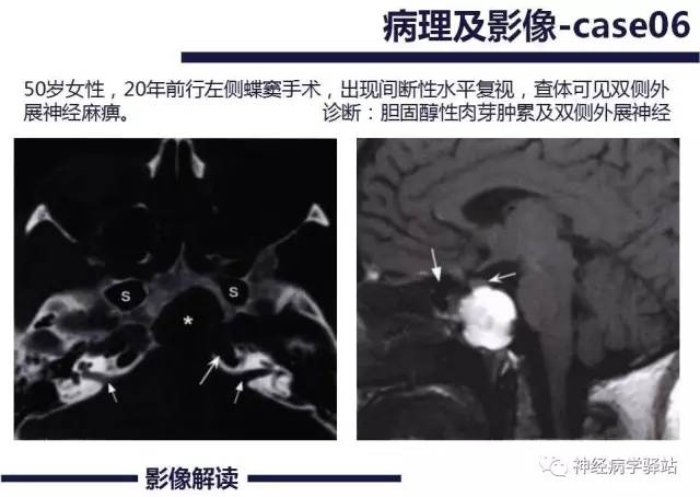 【PPT】展神经解剖、影像及临床