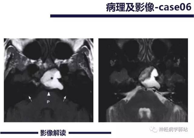 【PPT】展神经解剖、影像及临床
