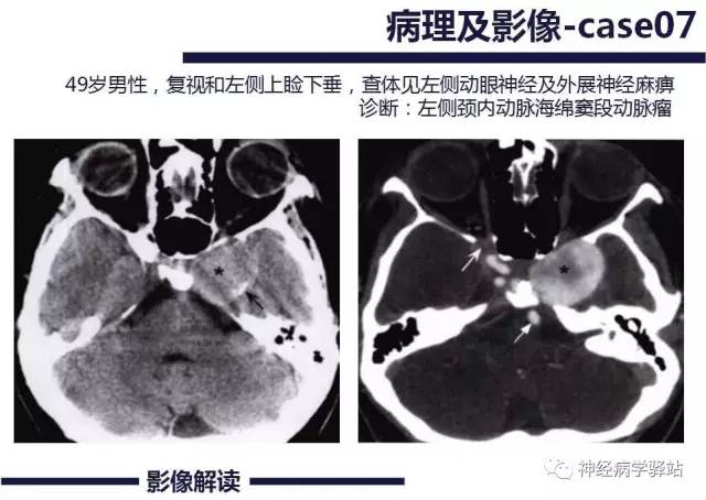 【PPT】展神经解剖、影像及临床