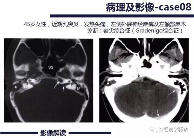 【PPT】展神经解剖、影像及临床
