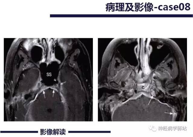 【PPT】展神经解剖、影像及临床