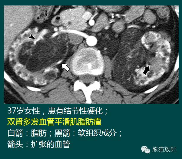 【PPT】成人肾脏间叶源性肿瘤 【PPT】成人肾脏间叶源性肿瘤