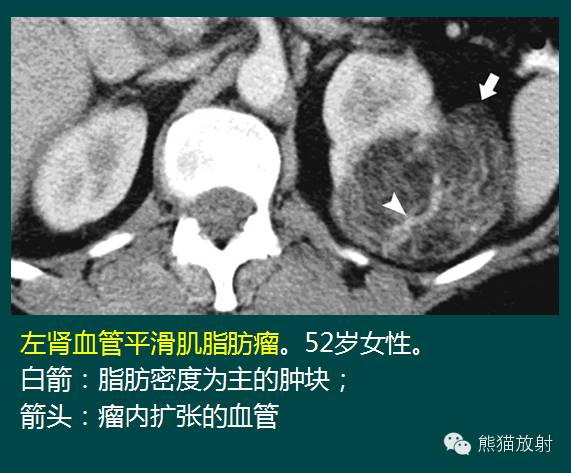 【PPT】成人肾脏间叶源性肿瘤 【PPT】成人肾脏间叶源性肿瘤