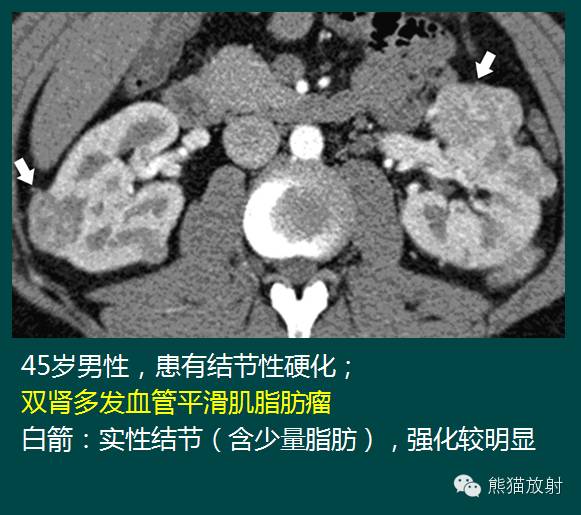 【PPT】成人肾脏间叶源性肿瘤 【PPT】成人肾脏间叶源性肿瘤