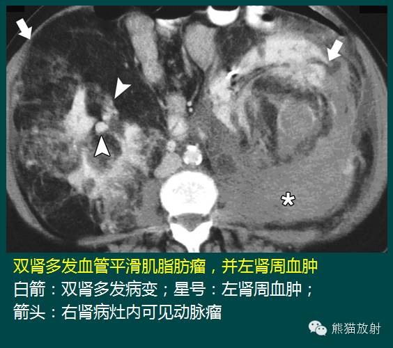 【PPT】成人肾脏间叶源性肿瘤 【PPT】成人肾脏间叶源性肿瘤
