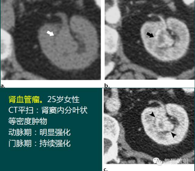 【PPT】成人肾脏间叶源性肿瘤 【PPT】成人肾脏间叶源性肿瘤