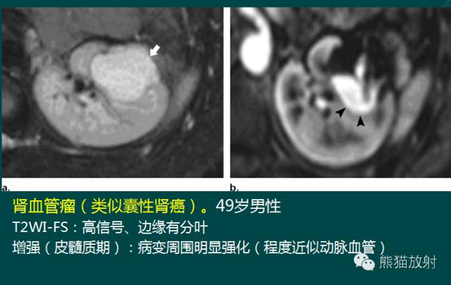 【PPT】成人肾脏间叶源性肿瘤 【PPT】成人肾脏间叶源性肿瘤