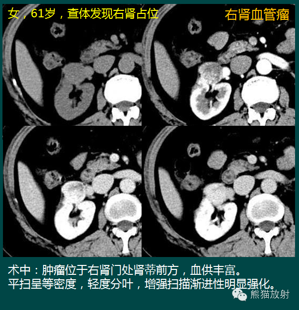 【PPT】成人肾脏间叶源性肿瘤 【PPT】成人肾脏间叶源性肿瘤