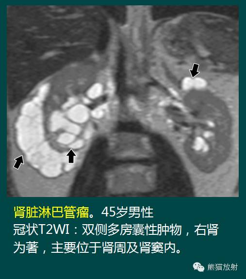 【PPT】成人肾脏间叶源性肿瘤 【PPT】成人肾脏间叶源性肿瘤