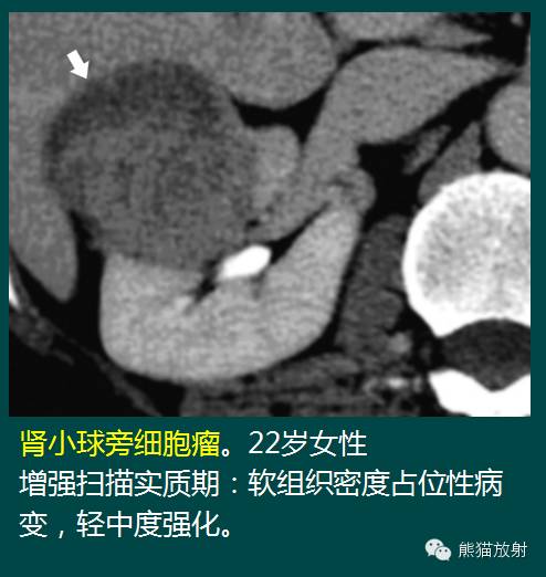 【PPT】成人肾脏间叶源性肿瘤 【PPT】成人肾脏间叶源性肿瘤