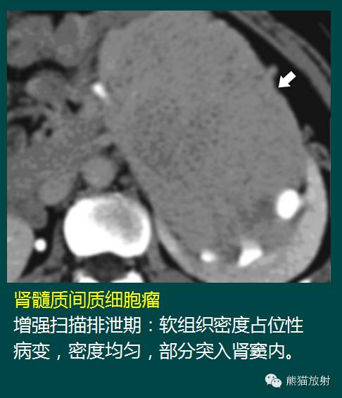 【PPT】成人肾脏间叶源性肿瘤 【PPT】成人肾脏间叶源性肿瘤