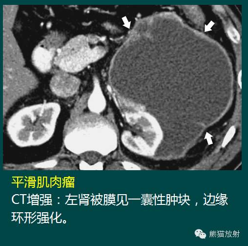 【PPT】成人肾脏间叶源性肿瘤 【PPT】成人肾脏间叶源性肿瘤