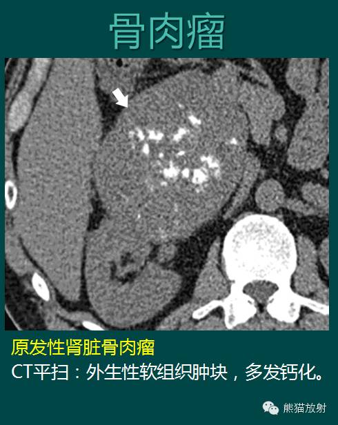 【PPT】成人肾脏间叶源性肿瘤 【PPT】成人肾脏间叶源性肿瘤