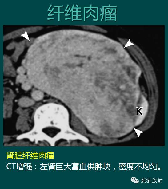 【PPT】成人肾脏间叶源性肿瘤 【PPT】成人肾脏间叶源性肿瘤