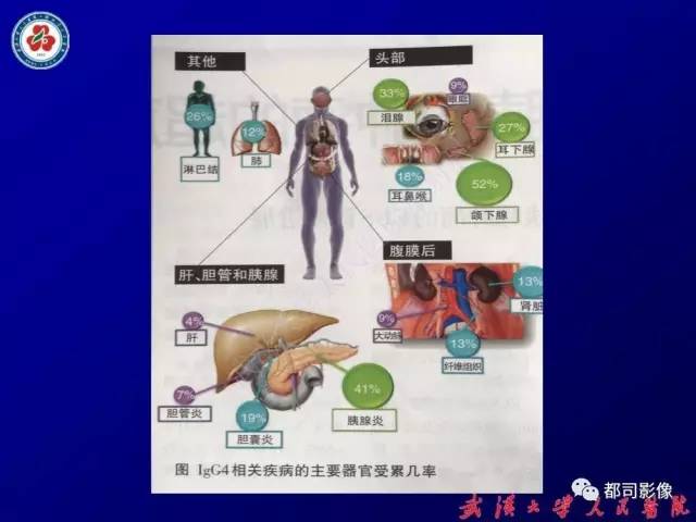 【PPT】IgG4相关疾病影像诊断
