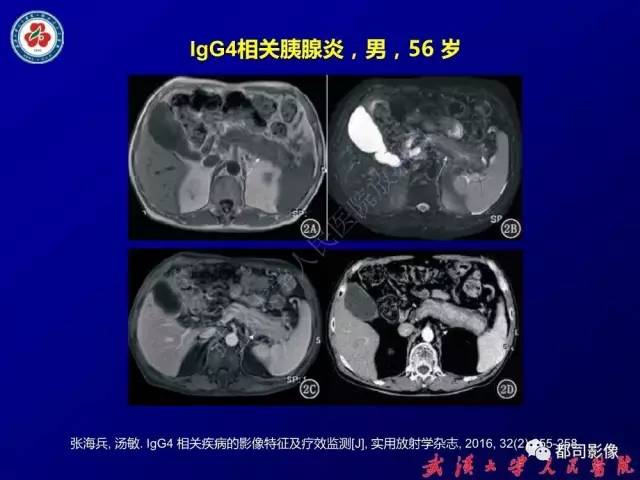 【PPT】IgG4相关疾病影像诊断