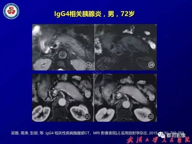 【PPT】IgG4相关疾病影像诊断