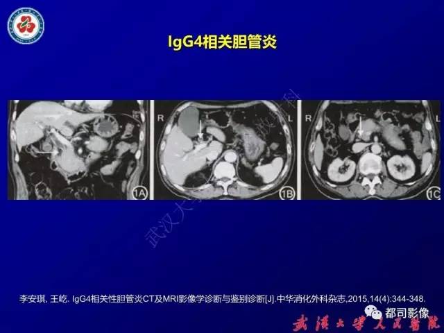 【PPT】IgG4相关疾病影像诊断