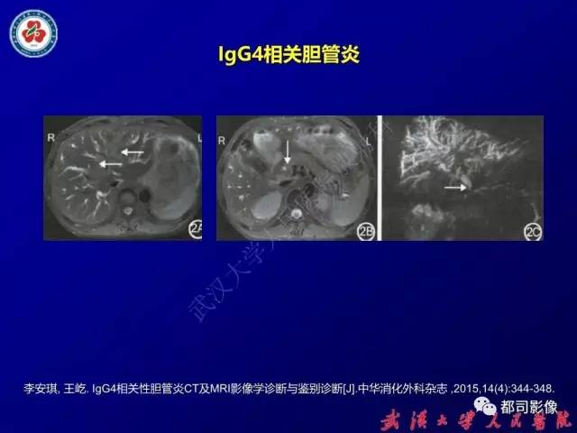 【PPT】IgG4相关疾病影像诊断