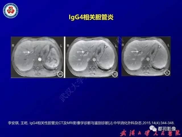 【PPT】IgG4相关疾病影像诊断