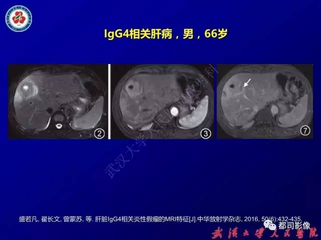 【PPT】IgG4相关疾病影像诊断