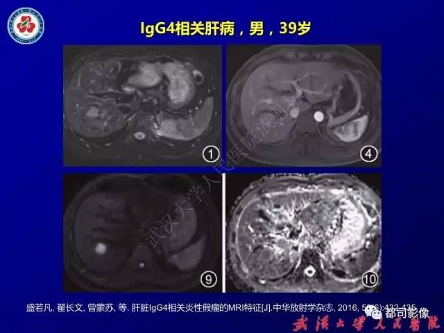 【PPT】IgG4相关疾病影像诊断