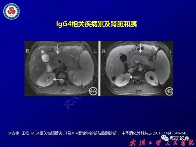 【PPT】IgG4相关疾病影像诊断