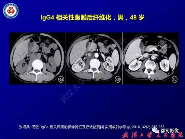 【PPT】IgG4相关疾病影像诊断