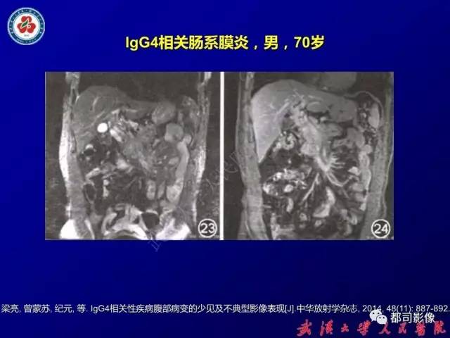 【PPT】IgG4相关疾病影像诊断