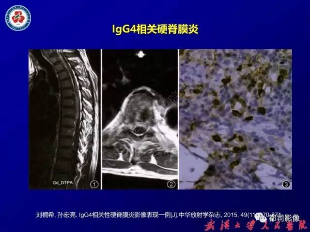 【PPT】IgG4相关疾病影像诊断