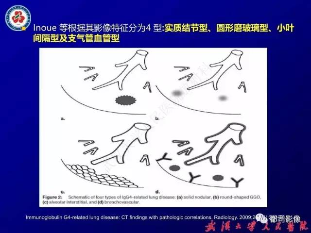 【PPT】IgG4相关疾病影像诊断