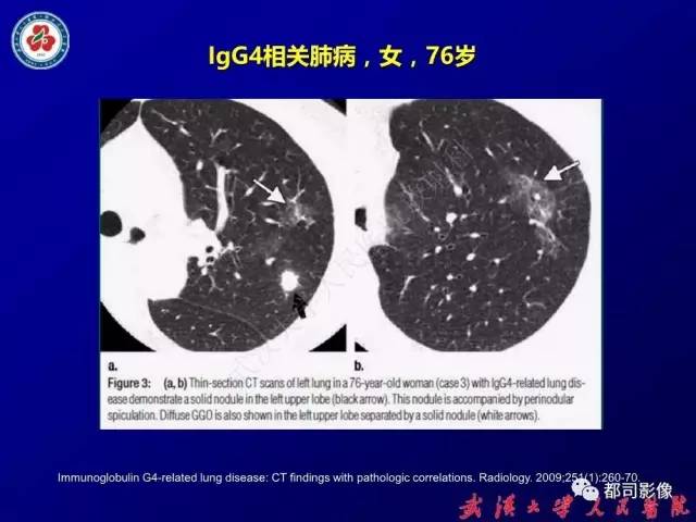 【PPT】IgG4相关疾病影像诊断