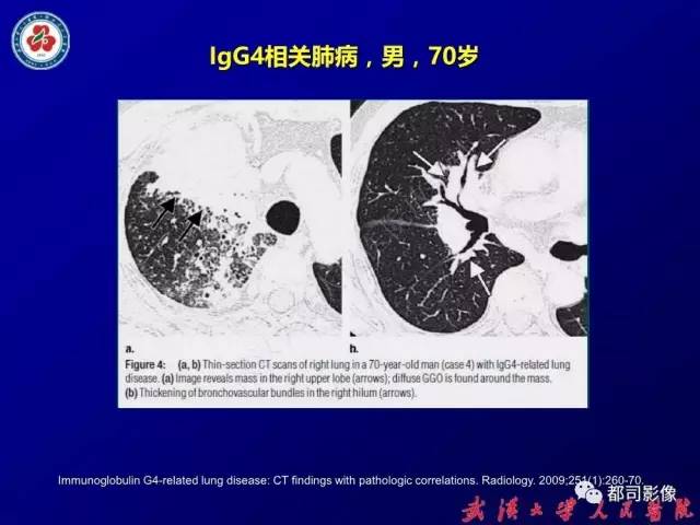 【PPT】IgG4相关疾病影像诊断