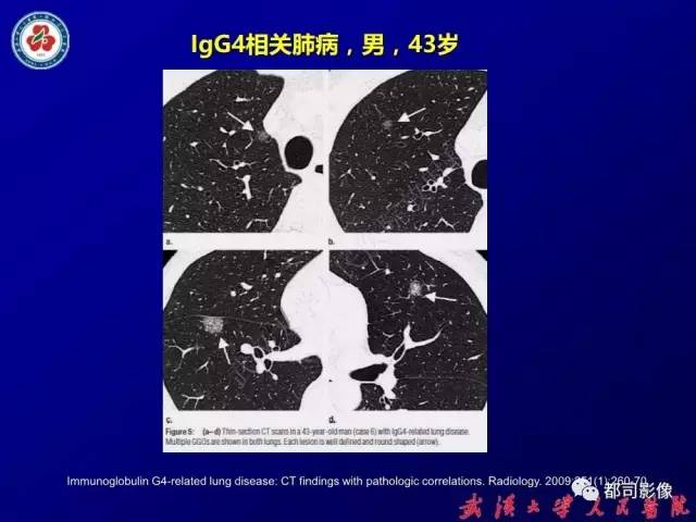 【PPT】IgG4相关疾病影像诊断