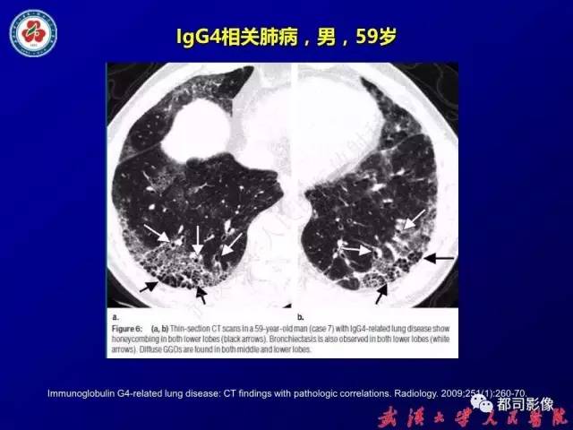 【PPT】IgG4相关疾病影像诊断