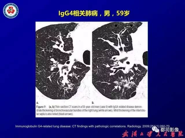 【PPT】IgG4相关疾病影像诊断