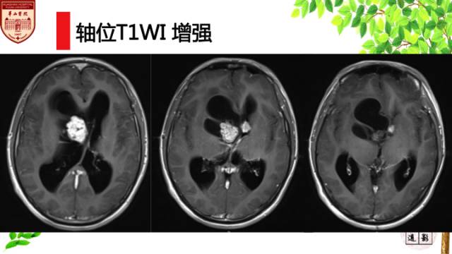 【病例】室管膜下巨细胞星形细胞肿瘤1例MR