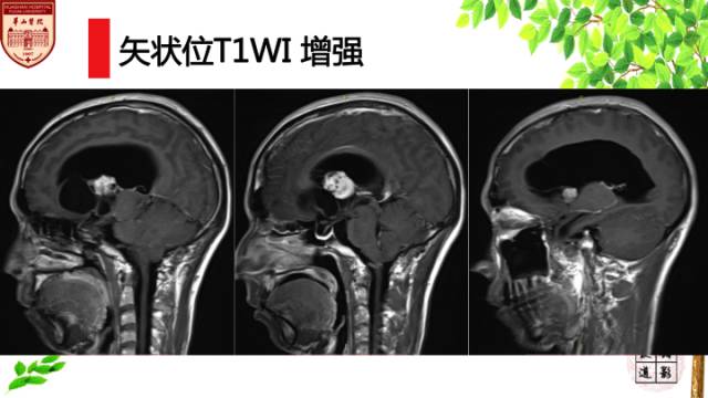 【病例】室管膜下巨细胞星形细胞肿瘤1例MR