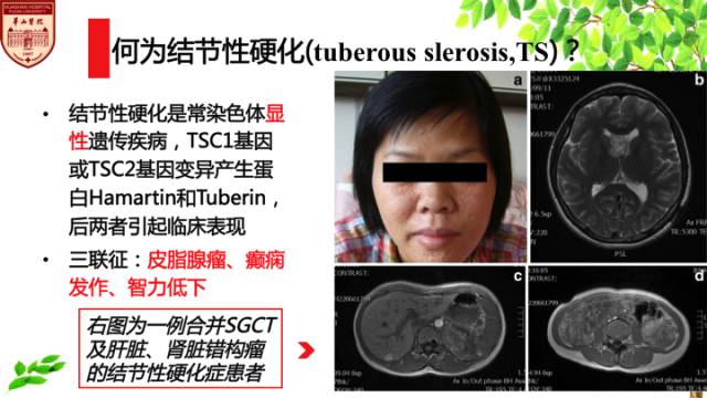 【病例】室管膜下巨细胞星形细胞肿瘤1例MR