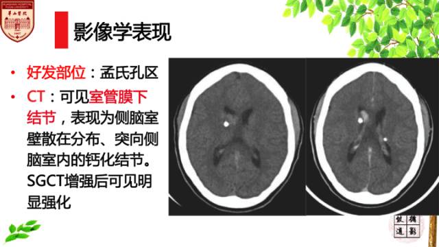 【病例】室管膜下巨细胞星形细胞肿瘤1例MR