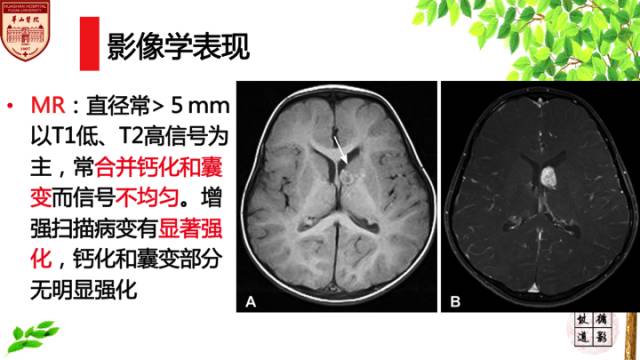 【病例】室管膜下巨细胞星形细胞肿瘤1例MR