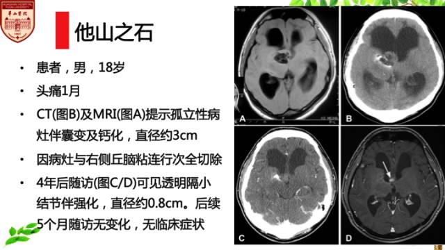【病例】室管膜下巨细胞星形细胞肿瘤1例MR