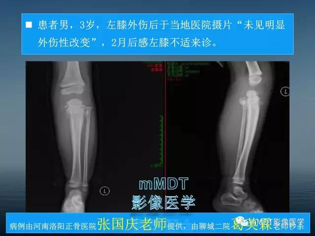 【PPT】无痛无汗症的影像诊断