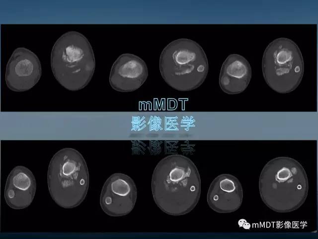 【PPT】无痛无汗症的影像诊断