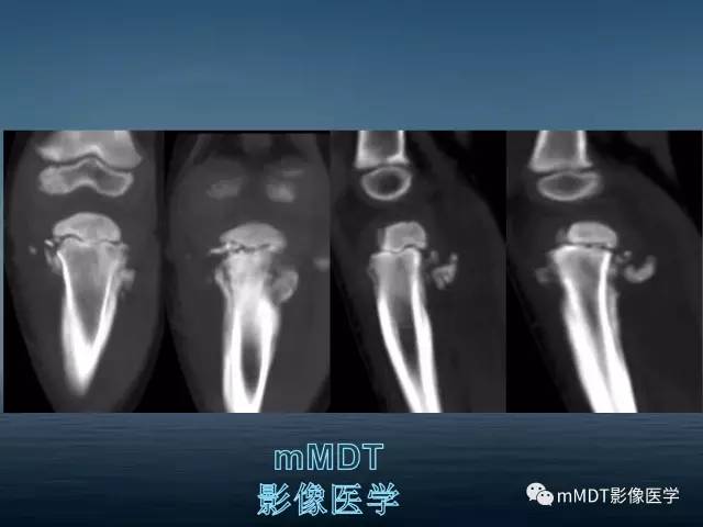 【PPT】无痛无汗症的影像诊断