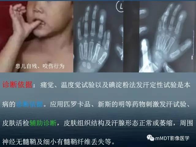 【PPT】无痛无汗症的影像诊断