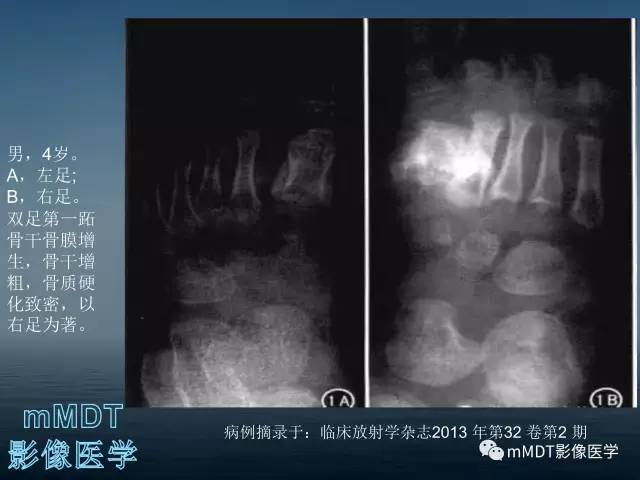 【PPT】无痛无汗症的影像诊断